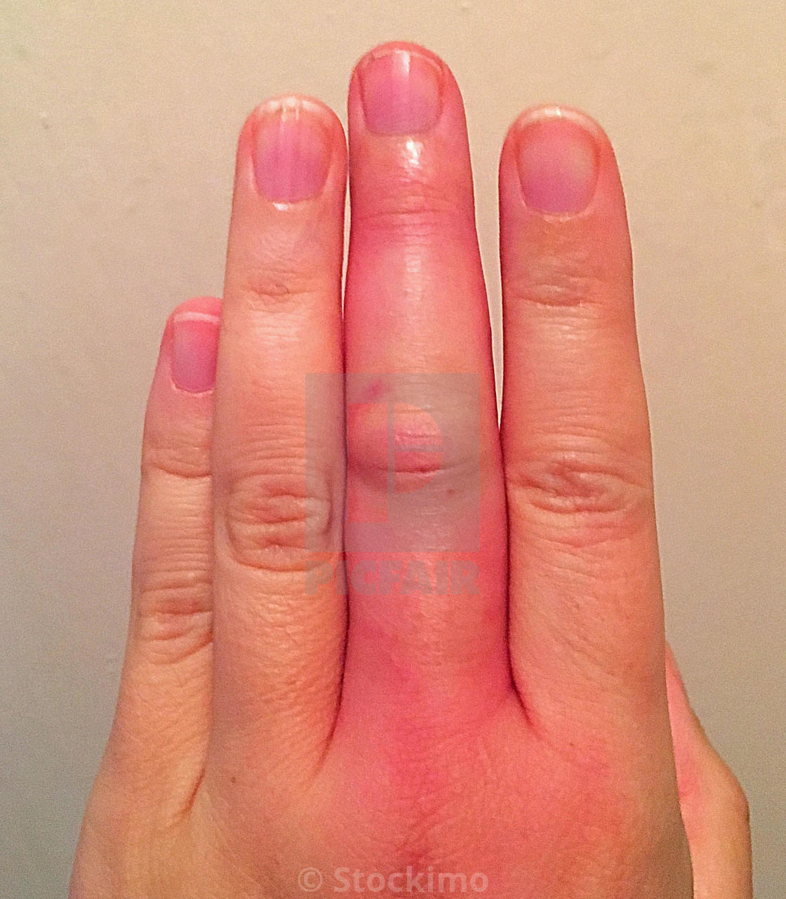 Swollen And Infected Finger From Insect Bite License Download Or